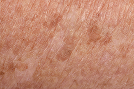 Tri Cities Skin Cancer Age Spots
