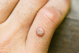 warts on skin or skin cancer