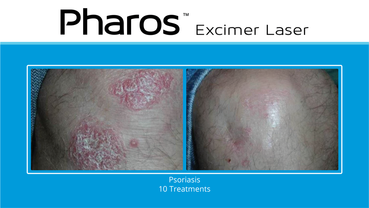 Pharos Excimer Laser_Psoriasis Before and After